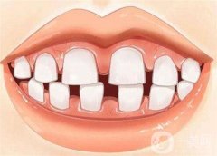 地包天是怎么形成的？地包天可以矫正吗