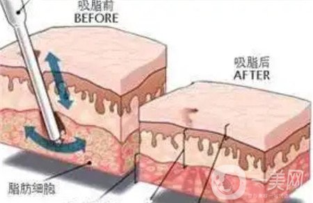 全身吸脂手术价格？冯斌做全身吸脂大概多少钱？