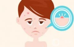 激光调节痤疮有副作用吗？