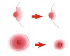 乳晕缩小手术果如何？果能维持多久？