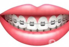 矫正牙齿选什么托槽?金属自锁托槽特点有哪些?优点是什么?
