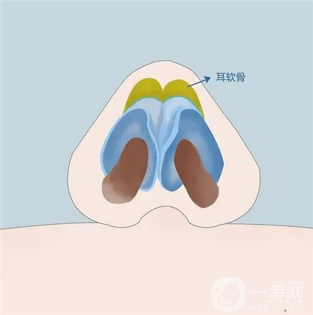 欧阳春肋软骨隆鼻真实案例恢复*果大公开