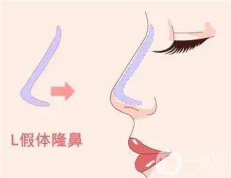 鼻部手术整形案例，术后3个月的恢复记录分享~