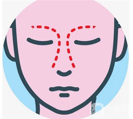 鼻部手术整形案例，术后3个月的恢复记录分享~