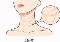 颈纹是怎么形成的？激光去除颈部皱纹后有哪些注意事项？