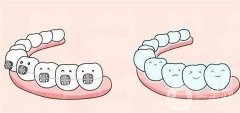 牙齿矫正会有牙套脸吗？如何改良？