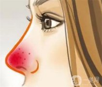 导致酒渣鼻形成的原因是什么？怎么调节