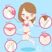 超冰脱毛器有什么优势？如何避免*脱毛的危害？