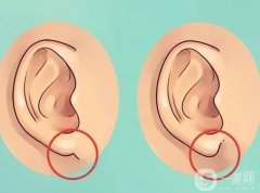 玻尿酸丰耳垂会栓塞吗？危害是什么