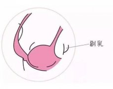 副乳切除对母乳喂养有没有影响？