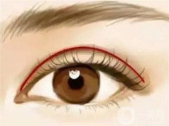 割双眼皮好不好？多久可以恢复？