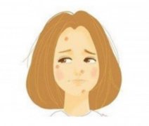 关于激光祛痘的体会？