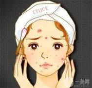 激光祛斑的优缺点？会不会反弹？