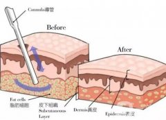 水动力吸脂有什么优点？会留疤吗