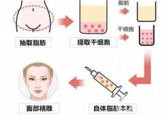如何自体脂肪填充的？