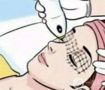 热玛吉塑形的优势在哪里？