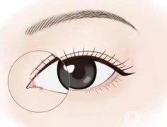 泪沟是什么?填充泪沟怎么样？