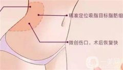 抽脂后是不是会反弹？抽脂后需要注意什么？