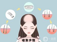 植发要不要剃光头？植发有几种方法？