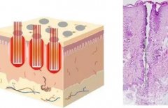 点阵激光有哪些优缺点？多久见
