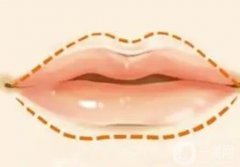 唇弓整形的方法有哪些？