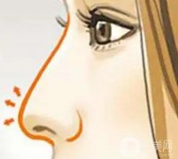 耳软骨垫鼻尖可以捏吗？需要多久才能恢复？