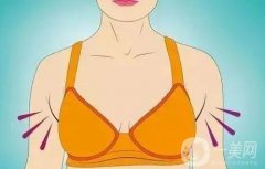 副乳切除术的步骤和注意事项