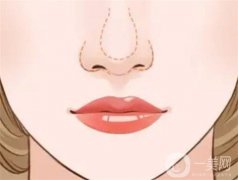 耳软骨垫鼻尖的好处是什么？会不会被吸收呢？