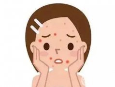 点阵激光祛痘印有果吗？果好吗？