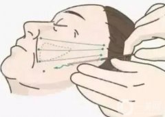 电波拉皮后的注意事项一般有哪些