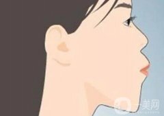 垫下巴要肿多久？消肿需要多久？