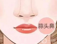 大蒜鼻应该怎么矫正？