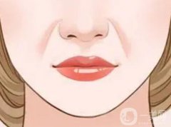 玻尿酸填充法令纹有什么缺点吗？