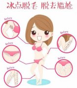 超冰脱毛的果是长久的吗？
