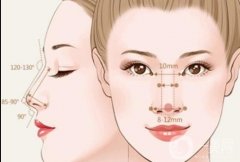 膨体隆鼻后鼻子软化需要多久？