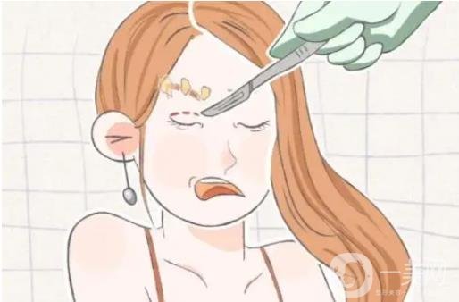 眼*整形全过程跟踪及术后恢复日记