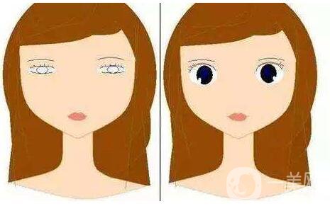 眼*整形全过程跟踪及术后恢复日记