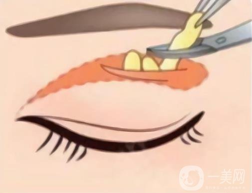 眼*整形全过程跟踪及术后恢复日记