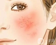 用激光去除红血丝吗？有副作用吗？