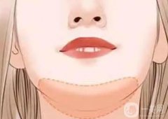 双下巴吸脂后怎么戴头罩？