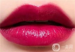 玻尿酸隆唇后多久能变软？