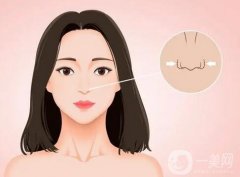 鼻翼内切的果可以长久保持吗？