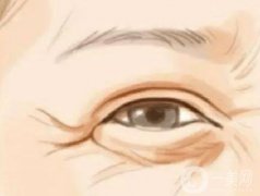 激光去鱼尾纹前有什么需要注意？