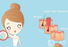 哪些因素决定冰点脱毛的价格？