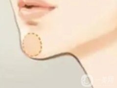 玻尿酸注射下巴的果能够持续多久？