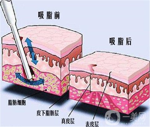 360环形抽脂手术大概要多少钱？