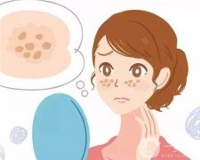 激光祛痘后会不会复发？怎么做才不会复发？