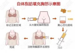 深V不再只是梦想，自体脂肪丰胸热门问题及解答介绍