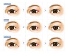 常见的眼部整形手术类型及眼部手术术后注意事项