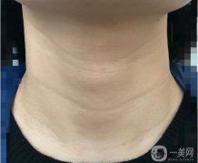 颈纹是什么原因造成的?你脖子上的纹身处于什么阶段?